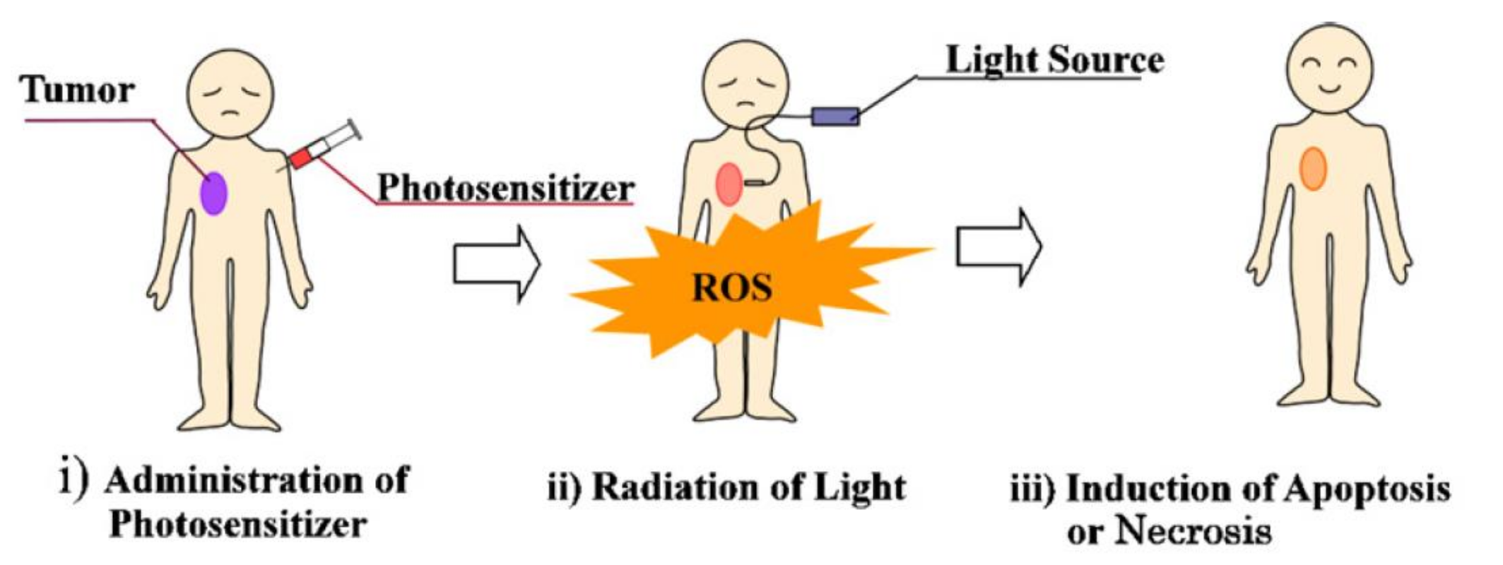 图1 PDT mechanism: profile of PDT treatment<sup>[3]</sup>. 